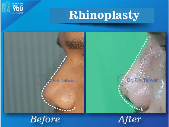 rhinoplasty surgery result